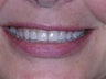Invisalign Teeth Straightening