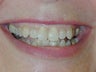 Invisalign Teeth Straightening