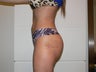 Brazilian Butt Lift