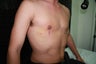 27 years British male suffering from male breast enlargement on right side for past 5 years