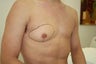 27 years British male suffering from male breast enlargement on right side for past 5 years