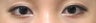 Asian Eyelid Surgery