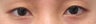 Asian Eyelid Surgery