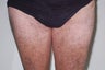 Lipoma Removal