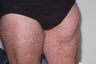 Lipoma Removal