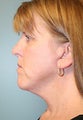 Female patient who underwent a neck lift 