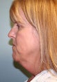 Female patient who underwent a neck lift 