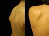 Smartlipo Triplex Lipoma Removal at Two Months