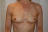 Breast Augmentation