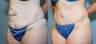 37 year old after mini tummy tuck