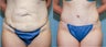 37 year old after mini tummy tuck