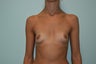 Breast Augmentation