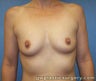 Breast Implants