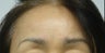 Brow Lift