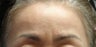 Brow Lift