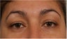 44 Year olf female with sagging of her eye brows and upper eye lids.  She doesn't want surgery
