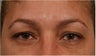 44 Year olf female with sagging of her eye brows and upper eye lids.  She doesn't want surgery
