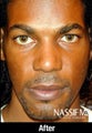 Male Ethnic Rhinoplasty 