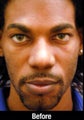 Male Ethnic Rhinoplasty 