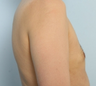 Male Breast Reduction