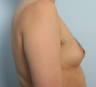 Male Breast Reduction