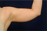Arm Lift - Liposuction
