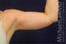 Arm Lift - Liposuction