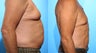 72 Year Old Man Chest Abdominal Chest, Love Handles , Abdominal Liposculpture 