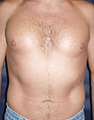 Pec Implants 