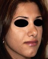 Rhinoplasty