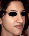 Rhinoplasty