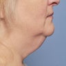 53 Year Old Female Treated For Turkeyneck