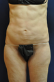Female Abdominal Liposuction 