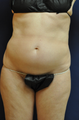 Female Abdominal Liposuction 