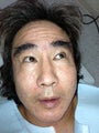 Acne Scarring-Ulthera, Fat Transfer, Mixto, PRP and Stem Cells -3 sessions