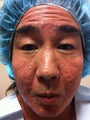 Acne Scarring-Ulthera, Fat Transfer, Mixto, PRP and Stem Cells -3 sessions