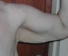 54 year old woman has Brachioplasty