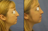 Rhinoplasty