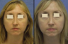 Rhinoplasty