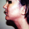 Chin Implant