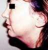 Chin Implant