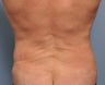 47 Year Old Male Treated For Love Handles