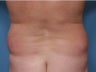 47 Year Old Male Treated For Love Handles