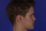 Rhinoplasty