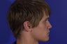 Rhinoplasty