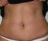 Tummy Tuck