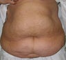 Tummy Tuck