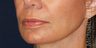 Structural Fat Grafting