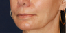Structural Fat Grafting