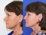 Ultherapy facial skin thightening 